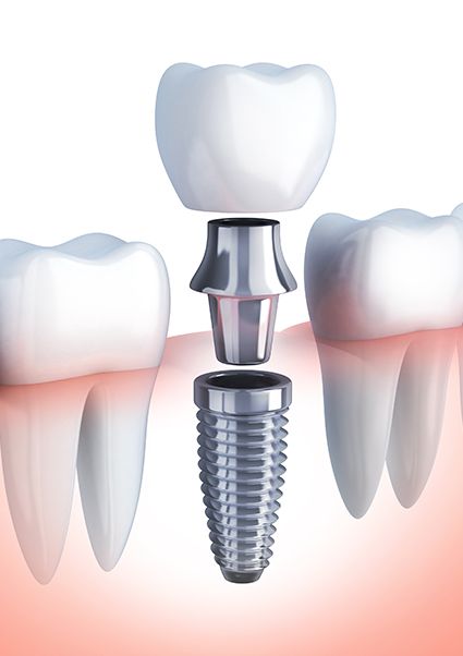 Dental implants diamond bar